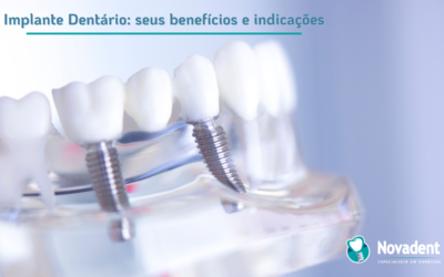 Implante Dentário: seus benefícios e indicações