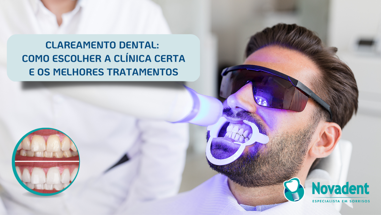 TIPOS DE CLAREAMENTO DENTAL E SEUS EFEITOS - NovaDent 2026