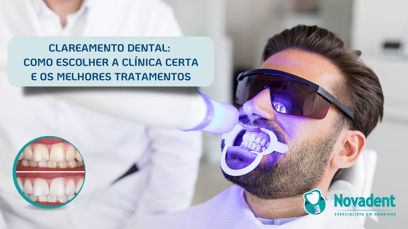 Clareamento dental